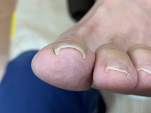 令和２年１２月２５日 糟屋郡新宮町在住 ４０代 ｋさん 巻き爪ビフォーアフター みつとも鍼灸整骨院 整体院
