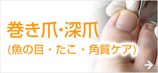 巻き爪