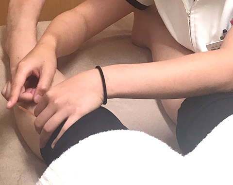 鍼治療